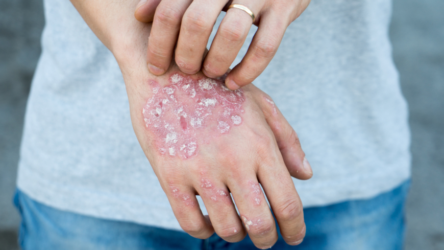 Blickar, kommentarer och låg förståelse från omgivningen är bara några exempel på vad personer med psoriasis ofta får hantera i sin vardag. Foto: Shutterstock